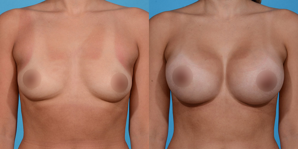 before and after breast augmentation Dallas front view Dr. Yash Avashia