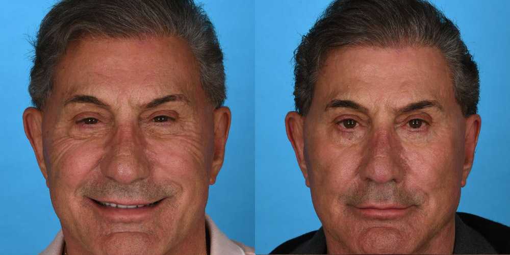 Before and after laser skin resurfacing in Dallas with Dr. Yash Avashia