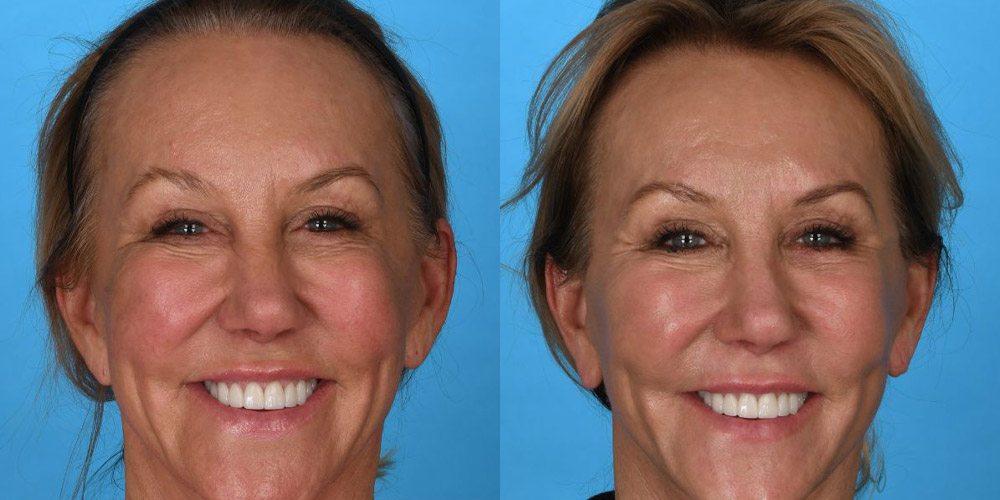 Before and after female face laser skin resurfacing in Dallas