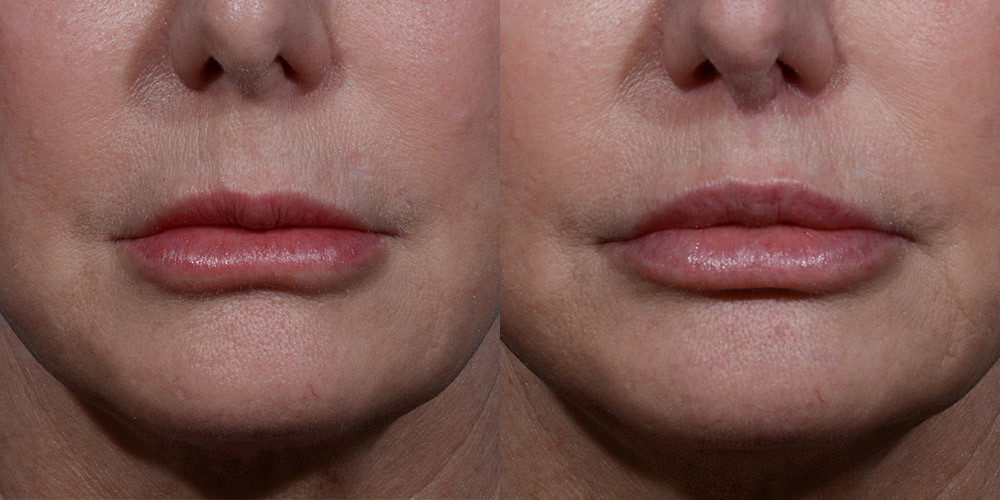 before and after lip lift Dallas with Dr. Yash
