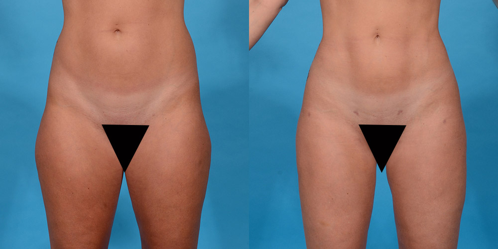 before and after female liposuction Dallas front view
