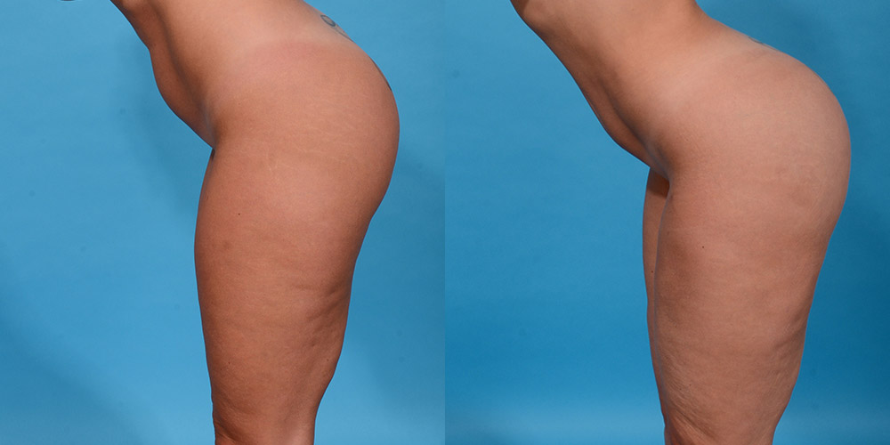 Before and after liposuction of the abdomen female side view