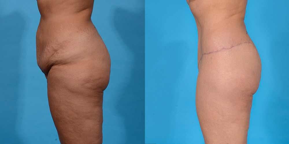 Before and after tummy tuck results side view
