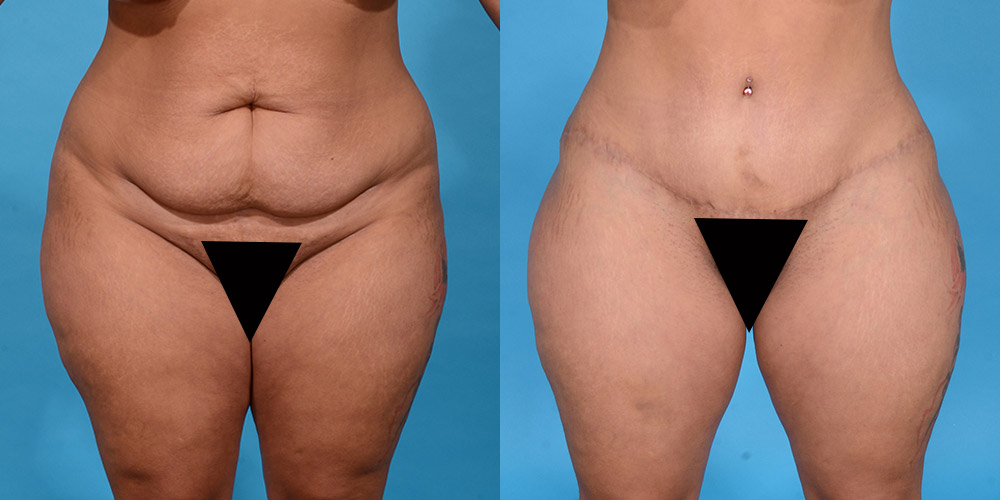 before and after tummy tuck results with Dr. Yash Avashia