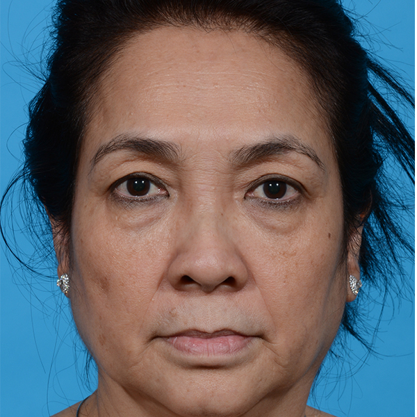 before facelift female patient front view with no smile case 8540