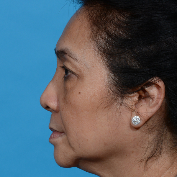before facelift female patient left side view case 8540