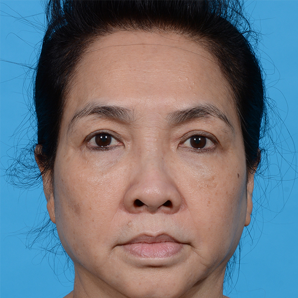 after facelift female patient front view with no smile case 8540