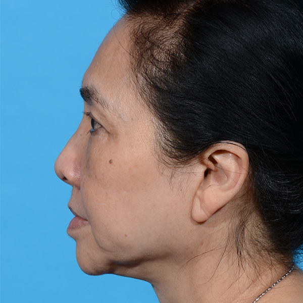 after facelift female patient left side view case 8540