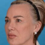 before facelift female patient left angle view case 8574