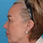 before facelift female patient left side view case 8574
