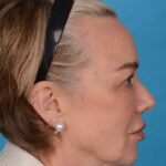before facelift female patient right side view case 8574