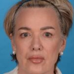 before facelift female patient front view with no smile case 8574