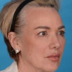 before facelift female patient right angle view case 8574