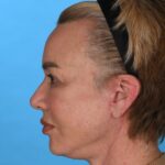 after facelift female patient left side view case 8574