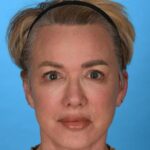 after facelift female patient front view with no smile case 8574