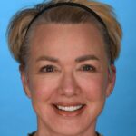 after facelift female patient front view with smile case 8574