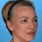 after facelift female patient right angle view case 8574