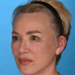 after facelift female patient left angle view case 8574