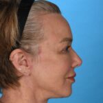 after facelift female patient right side view case 8574