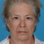 before facelift female patient front 2nd view case 8587