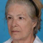 before facelift female patient left angle view case 8587