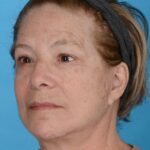 after facelift female patient left angle view case 8587