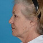 before facelift female patient left side view case 8587