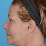 after facelift female patient left side view case 8587