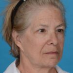 before facelift female patient right angle view case 8587