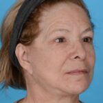after facelift female patient right angle view case 8587
