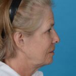before facelift female patient right side view case 8587