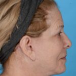 after facelift female patient right side view case 8587