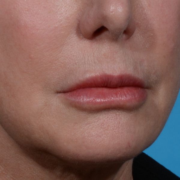 before lip lift right angle view case 8440