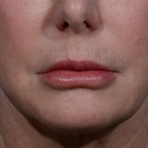 before lip lift front view no smile case 8440