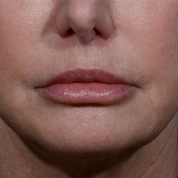 after lip lift front view no smile case 8440