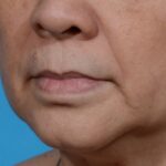 before lip lift right angle view no smile case 8458