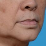 before lip lift right angle view no smile case 8458