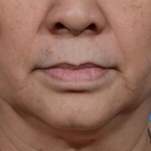 before lip lift front view no smile case 8458