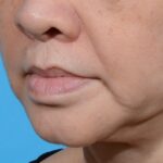 after lip lift right angle view no smile case 8458