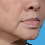 after lip lift right angle view no smile case 8458