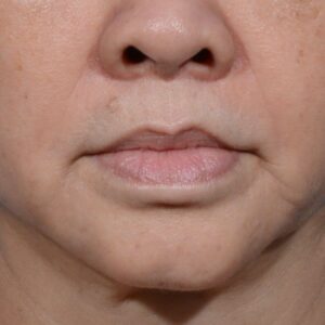 after lip lift front view no smile case 8458