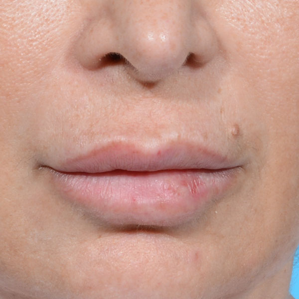 before lip lift female patient front view no smile case 8507