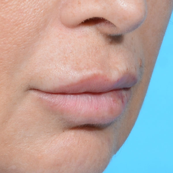 before lip lift female patient right angle view case 8507