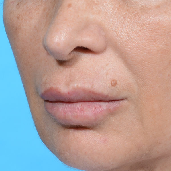before lip lift female patient left angle view case 8507