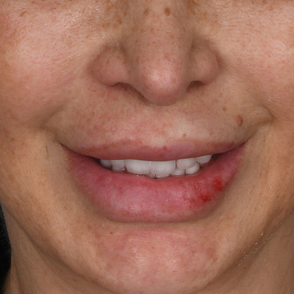 after lip lift female patient front view case 8507