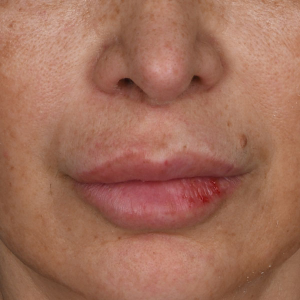 after lip lift female patient front view no smile case 8507