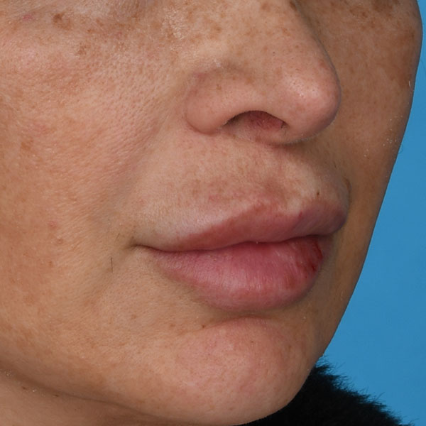 after lip lift female patient right angle view case 8507