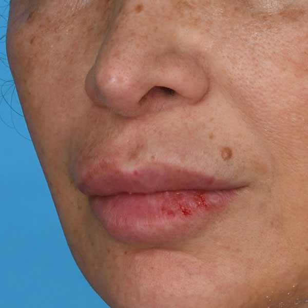 after lip lift female patient left angle view case 8507