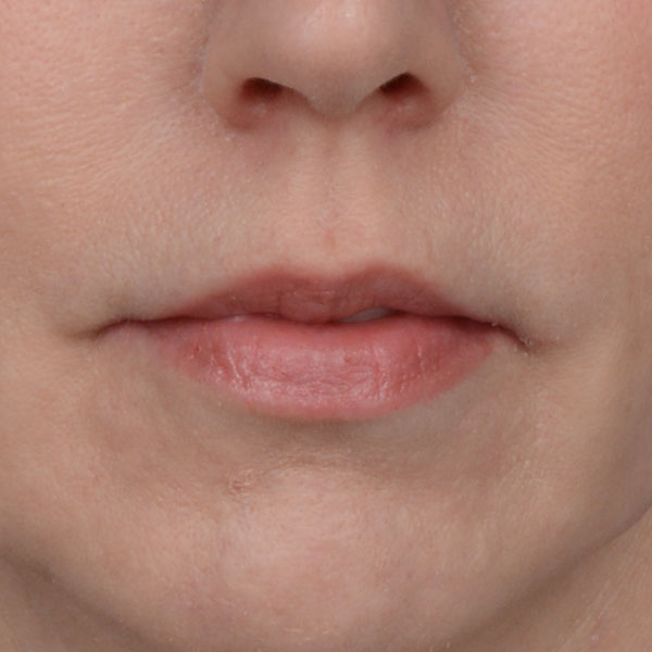 before lip lift front view female patient no smile case 8517