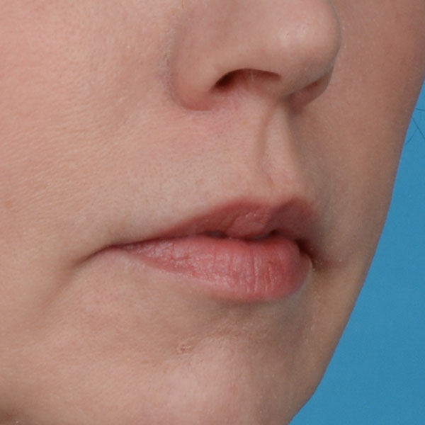 before lip lift front view female right angle view case 8517